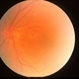 Wet Macular Degeneration Wet Macular Degeneration